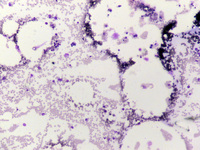 Dyskeratosis-Congenita