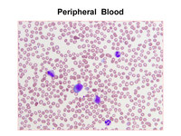Acute Megakaryoblastic Leukemia