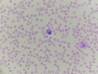 Pelger–Huët anomaly