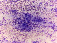 Metastatic Neuroblastoma