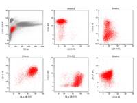Refractory-anemia-with-excess-blasts2-RAEB2-7