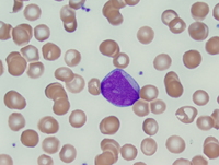 Acute-myeloid-leukemia-with-myelodysplasiarelated-changes-2