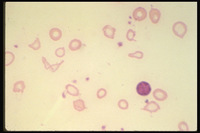 Iron-Deficiency-Anemia-Severe