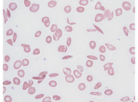 Sickle cells