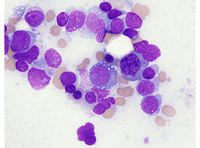 Vacuolated erythroid precursors