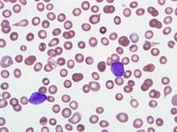 Relapsed-CD-34-ALL-Peripheral-Blood