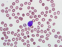 Relapsed-CD-34-ALL-Peripheral-Blood