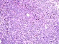 Relapsed-CD-34-ALL-Biopsy