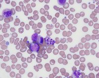 Degenerating neutrophil