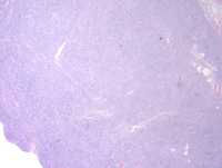 Nodular lymphocyte predominant Hodgkin lymphoma: Typical pattern