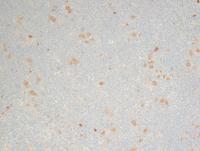 CD30-highlights-HRS-cells