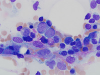 Refractory Cytopenia of Childhood