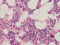 Refractory-cytopenia-of-childhood-GATA2-deficiency-related-Biopsy