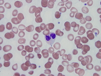 Refractory-cytopenia-of-childhood-GATA2-deficiency-related-Peripheral-blood