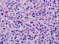 WHIM-Syndrome-Biopsy