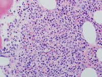 WHIM-Syndrome-Biopsy