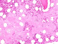 Pinky blushy bone trephine biopsy section!