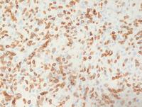 Lennert lymphoma (Lymphoepithelioid variant)