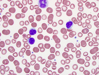 Chronic lymphoproliferative disorder of NK cells 2