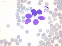 Neuroblastoma with bone marrow invasion 3