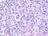 Reed Sternberg Cells 1