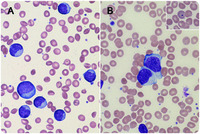 Epstein-Barr virus–associated lymphocytosis masquerading as lymphoma