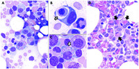 Hemophagocytosis by neoplastic plasma cells in multiple myeloma