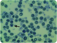 Revision of the diagnosis of a case of hereditary hemolytic anemia by supravital staining
