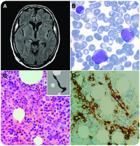 Rapidly progressive neurological deterioration without magnetic resonance imaging abnormalities: intravascular lymphoma