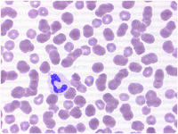 Borrelia hermsii relapsing fever