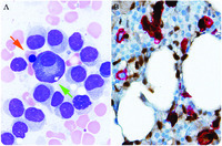 Chance identification of synchronous hairy cell leukemia and plasma cell myeloma in a potential HSC donor