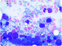 Bodies of evidence? Lymphoglandular bodies in aspirate smears of bone marrow involved by aggressive large B-cell lymphoma