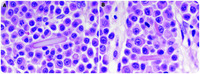 Extracellular and intracellular crystal deposition in plasma cell myeloma