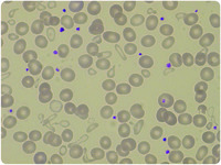 A double red cells population in a woman with a microcytic anemia