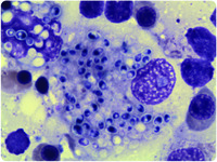 Bone marrow aspirate showing Histoplasma capsulatum