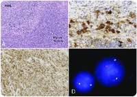 Relapsed nodular sclerosis Hodgkin lymphoma and therapy-related myeloid sarcoma in a mediastinal mass