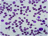 Doublet spherocytes