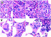 Coexistent BCR-ABL1 and JAK2 V617F: converting CML dwarves to ET staghorns with imatinib therapy