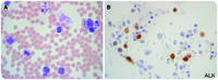 Small-cell variant of ALK anaplastic large-cell lymphoma with a leukemic phase