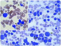 Pancytopenia in a patient with methylmalonic acidemia
