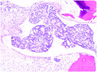 Metastatic prostate cancer mimicking thrombotic thrombocytopenic purpura