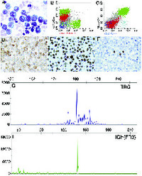 T-cell primary effusion lymphoma with pseudo-monoclonal rearrangements for immunoglobulin heavy chain