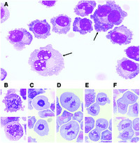 Dividing plasma cells in the cerebrospinal fluid of a patient with refractory multiple myeloma