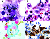 Hemophagocytic lymphohistiocytosis in a patient with granulomatosis with polyangiitis (Wegener's granulomatosis)