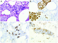 Small cell lung cancer mimicking high-grade lymphoma in a patient with concurrent B-cell lymphoproliferative disorder