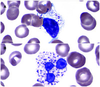 Effects of chloroquine therapy on white blood cells