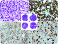 EBV-associated Aggressive Natural Killer-cell Leukemia