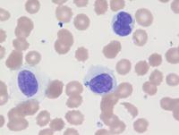 Hairy cell leukemia