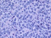 Primary bone lymphoma