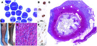 Primary effusion lymphoma and concurrent progressive Kaposi sarcoma associated with elevated interleukin-6